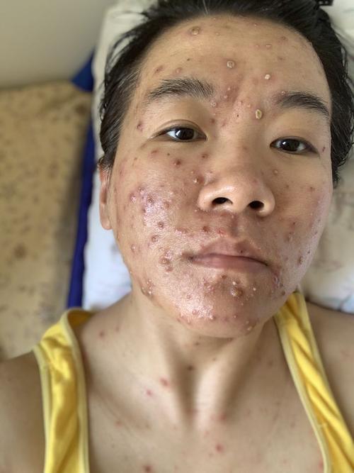 成人长水痘是什么样的经历?