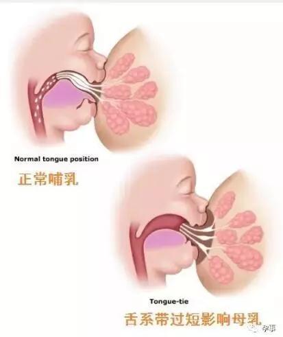 母乳喂养需要宝宝在吸吮时,将舌头放在下龈上,用舌头吮吸乳房,以便从