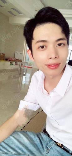 韩式双眼皮术后136天_全切双眼皮术后136天_眼型矫正术后136天_眼综合