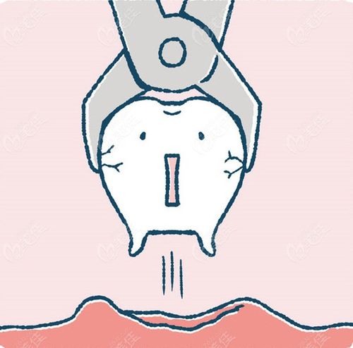 济南维乐口腔是微创拔牙哦