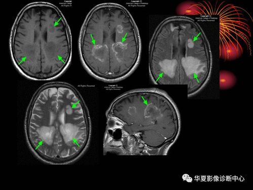 肿瘤样脱髓鞘病变影像特征以及鉴别诊断