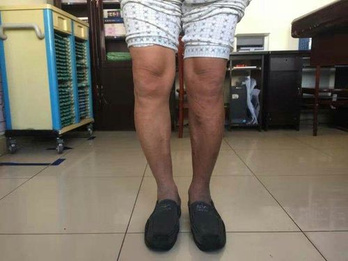 膝内翻(o型腿)的治疗