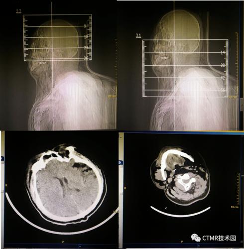 ct技术基于同一定位像不同扫描的合并