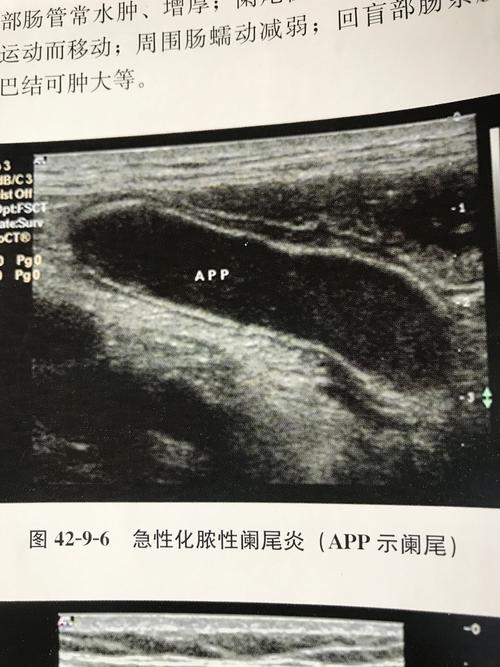 大多数阑尾炎是粪石梗阻引起