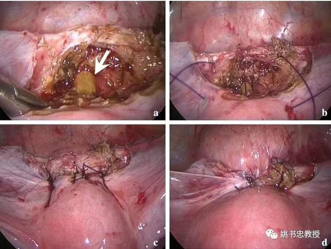 剖宫产瘢痕憩室需要治疗吗