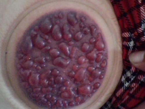 拔罐有何作用? 对腰疼怎么拔? 有懂得的吗?说说呀?