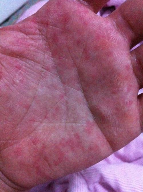 手心有小红点 一摁觉得有点痛有点痒,也没吃什么药