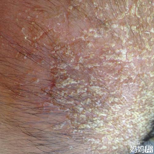 湿疹我恨死你了,跪求治湿疹方法