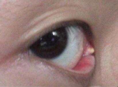 眼角里面长了两个白色的小点,如图所示,医院检查了一下说是角膜炎