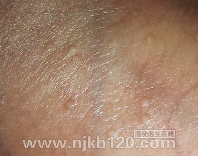 包皮上有白色小颗粒是不是尖锐湿疣