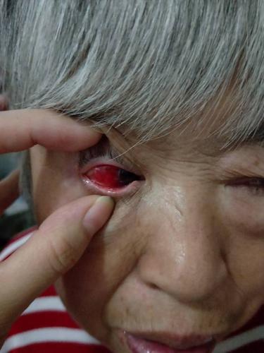右眼的右半边白眼球出血,一片血红,这是出了什么问题?