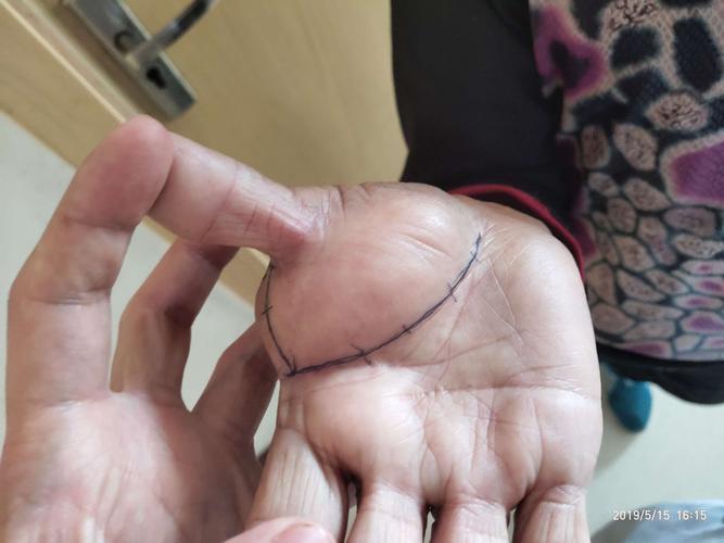 手部巨大脂肪瘤一例!(副本)