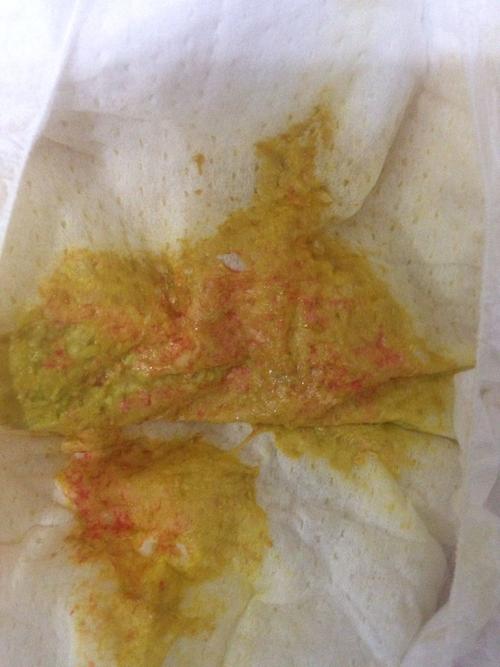 4个半月宝宝拉的便便有血丝,之前都是正常的,求各位专家医师看到回复