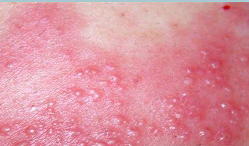 自体敏感性湿疹