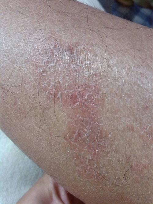 小腿内测出现一块这种大的红的皮,有点像鱼鳞的感觉,不痛也不痒,有两