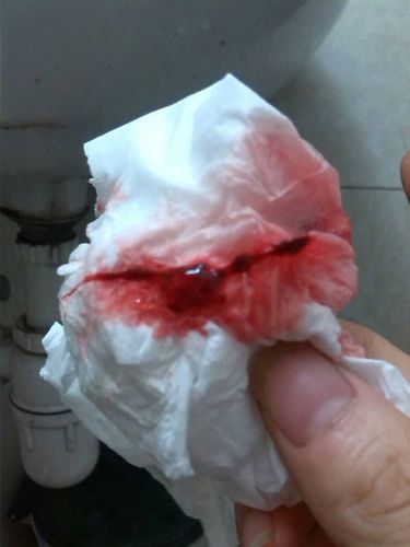 你好,我的月经量很少很少,还有很多瘀血.怎么办