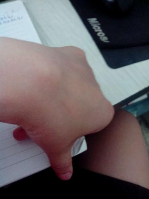 我想知道我手腕处鼓起一个包很硬就像骨头一样 按的话会疼这是什么