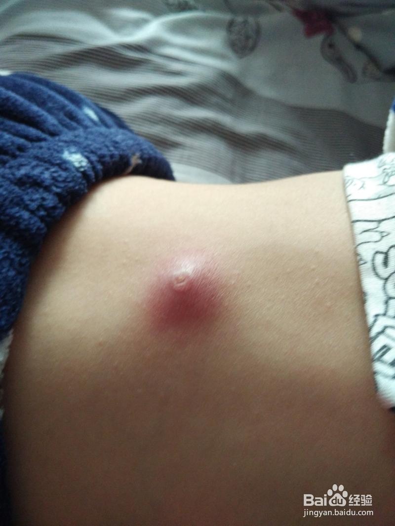 儿童背部疖子治疗全纪录