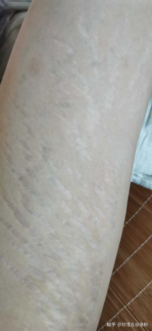 有的不知道是生长纹还是肥胖纹不过我的大腿确实有点粗000001