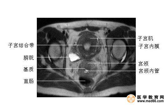 女性盆腔病变mri诊断