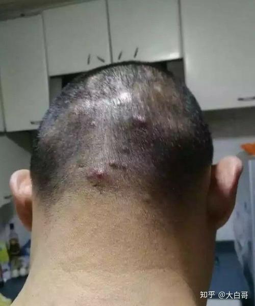 什么是毛囊炎怎么引起的