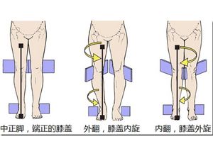 膝内翻膝外翻或髋内翻,膝内翻膝外翻或髋内翻是怎么的