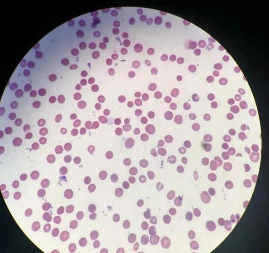 一例球形红细胞增多的思考