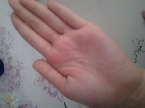 手被老师用竹条打了20多怎么消肿手背