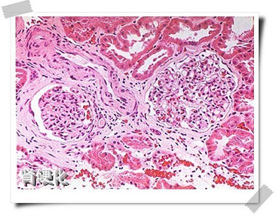 肾硬化镜下(图)