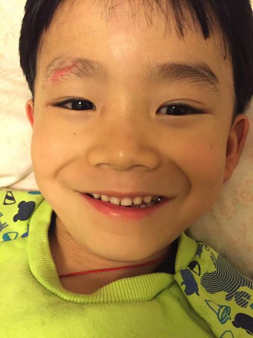 儿子7岁,11月7日晚上眉毛磕破缝针,当时太着急,慌了就