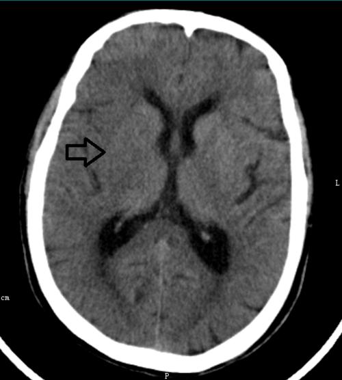超急性期大面积脑梗死 ct 平扫表现