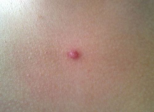 刚前几天一个同学去切了一个蛮大的血管瘤,难道.求帮助啊