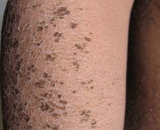 通常在小朋友身体上出现的鱼鳞病为先天性鱼鳞病,可是,不管是哪种类型