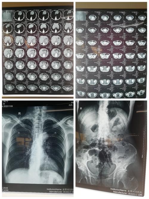 该病人腹部ct及胸腹部平片,未见气液平面.
