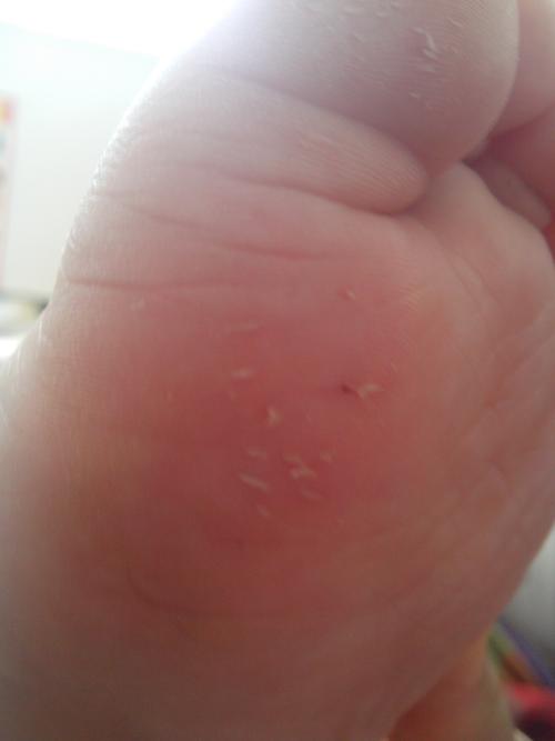 宝宝脚丫子前脚根大拇指下面起刺这个是怎么回事