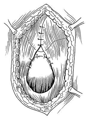 疝囊内容物可能只有腹膜外脂肪组织.