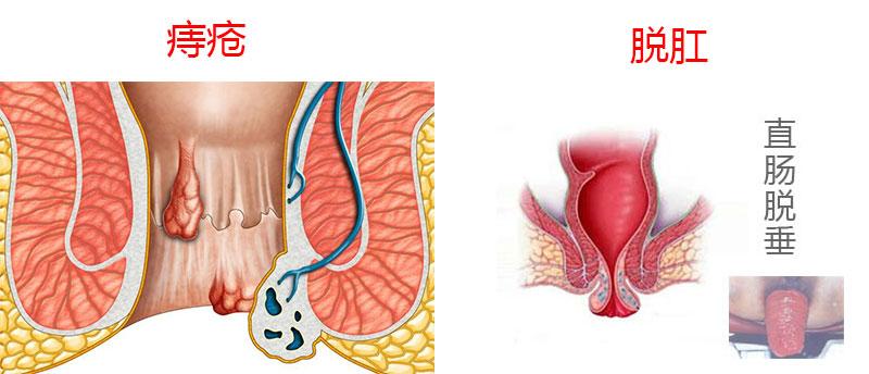 肛肠疾病 直肠脱垂 一,识别脱肛        脱肛很容易和痔疮进行混淆