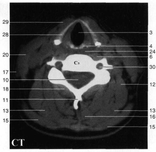 甲状软骨右板right lamina of thyroid cartilage 29.