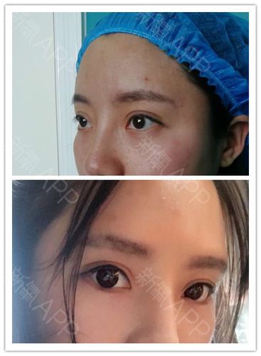 魏志香@假体眉弓案例展示图示案例为膨体丰_圈子-新氧美容整形