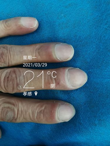 典型杵状指患者手指图片