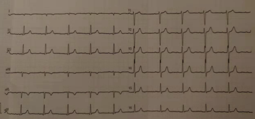 【临床干货】如何一眼识别心电图导联接反?
