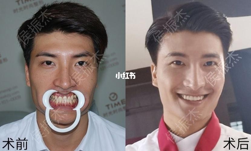 地包天面相"苦"?及早解决!_口腔_设计_社交_工作_艺术