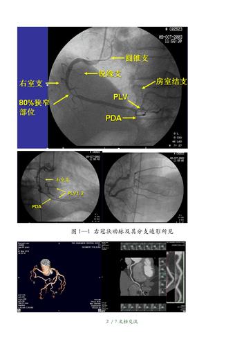 右冠状动脉的解剖学(干货分享)