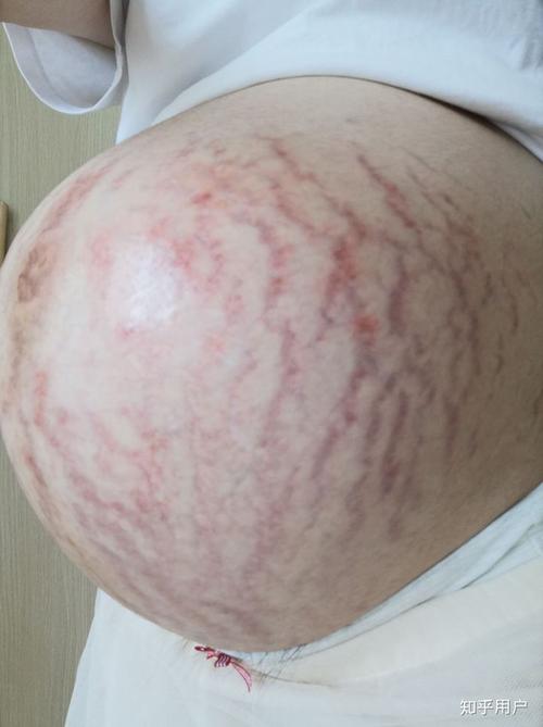 女人生完孩子后肚子的真实状态是怎样的?