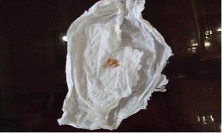 图片二  这是一个尿酸盐在淋巴大量结晶没有及时治疗出现迁延病变的