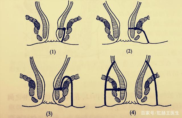 低位单纯性肛瘘当然应该及时手术治疗,避免发展成为高位复杂性肛瘘.
