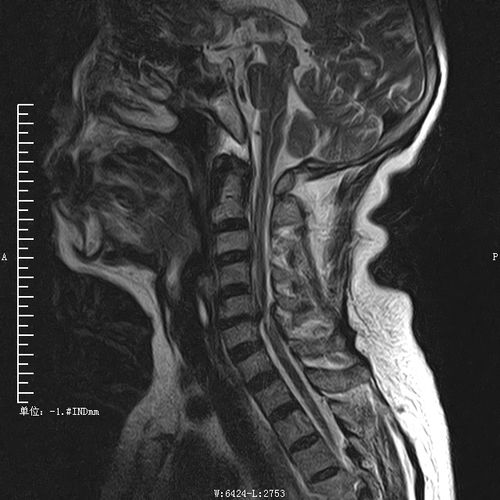 患者颈椎核磁