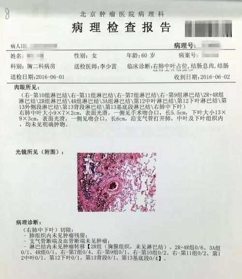 如此结节竟是肺癌-肺内结节治疗