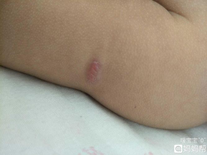 宝宝出生种花鼓起来个包,有一样的宝妈吗?