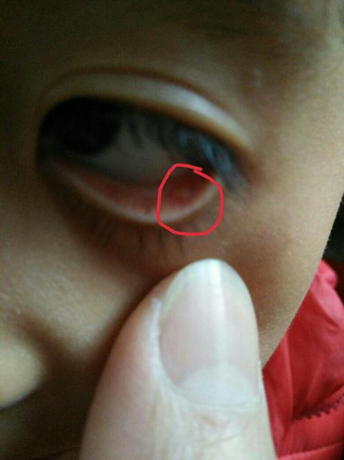 就是红圈里的那个,问了不疼也不痒,不像麦粒肿也不像散粒肿,宝宝不让